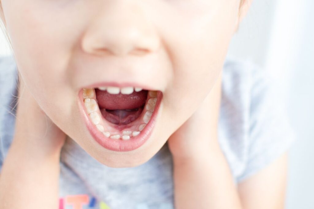 A child with double teeth known as shark teeth