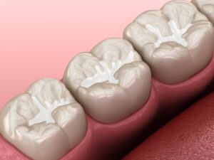 Dental sealants. 